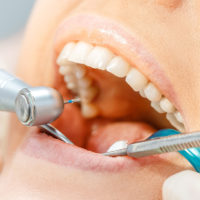 درمان ریشه مرکز دندانپزشکی دکتر آیدا ابراهیمی