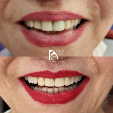 درمان ترکیبی لمینت و روکش تمام‌ سرامیک ایمکس چهار دندان قدامی فک بالا به رنگ طبیعی